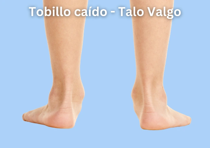 talo valgo tobillos vencidos