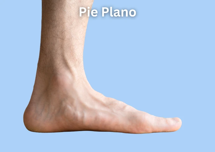 pie plano y cavo arco caido