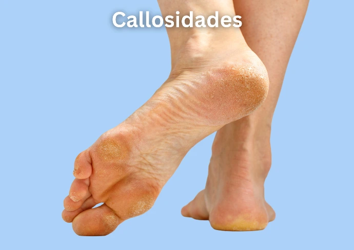 callo pie callosidad
