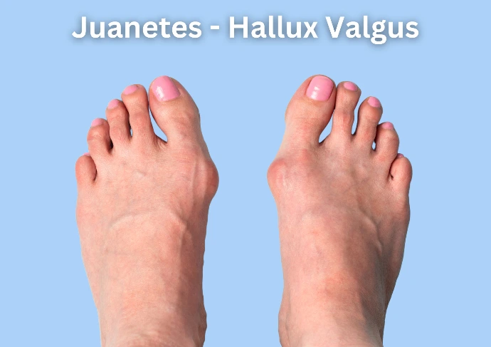 Juanetes Hallux Valgus