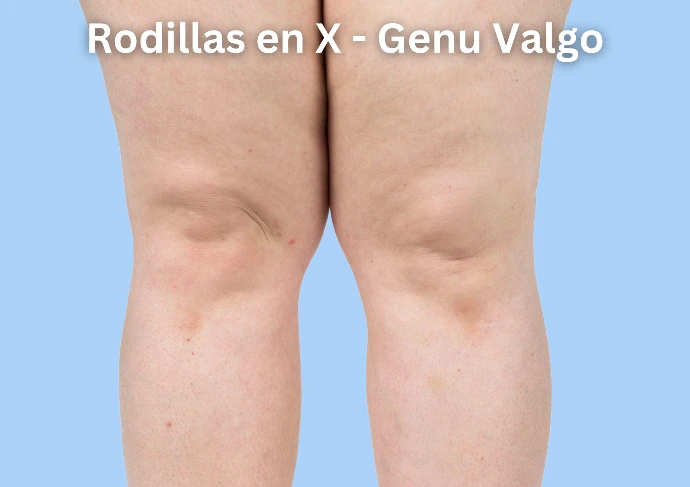 Dolor de rodillas en x