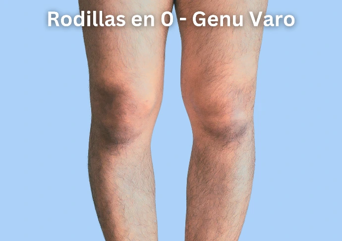 Dolor de rodillas en o de charro