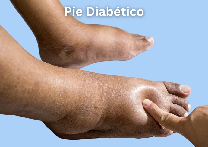 pie diabetico hinchado
