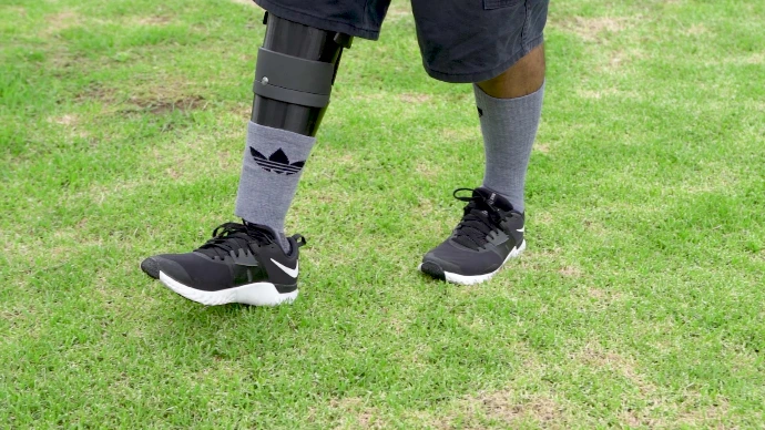 Prótesis de pierna inmediata con socket ajustable, diseñada para facilitar la adaptación inicial